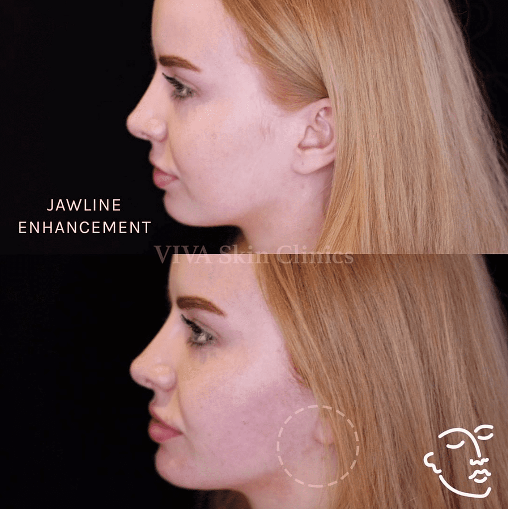 Screenshot 2019 08 27 at 14.21.43 1022x1024 Juvederm VOLUX - Women's Jawline Filler