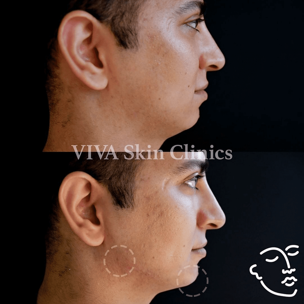 Screenshot 2019 08 27 at 14.22.29 1024x1022 Juvederm VOLUX - Men's Jawline Filler
