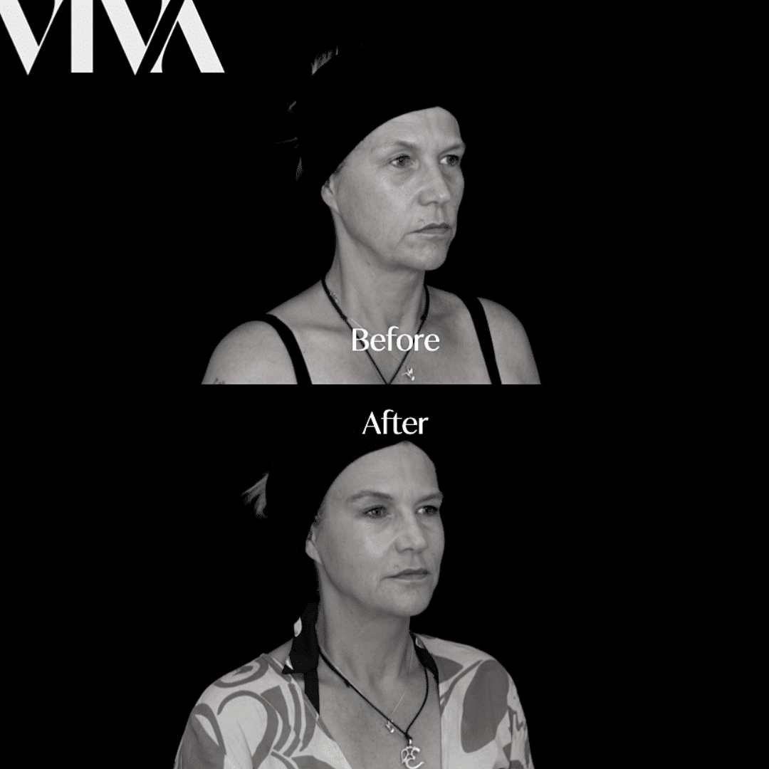 dermal filler