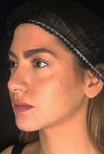 ChinAfterWebsite 203x300 ChinAfterWebsite 203x300