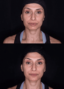 Non surgical facelift 1 214x300 Non surgical facelift 1 214x300