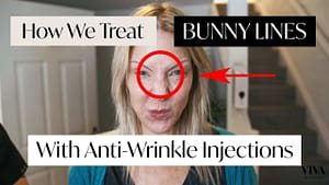 0sup8zvjx7g 300x169 Anti wrinkle injections used on bunny lines