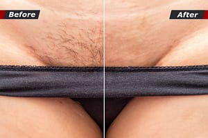 1373439128 huge 1 300x200 laser hair removal before and after bikini