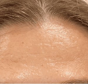 Botox london after