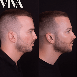 mens dermal filler treatment before and afters mens jawine and cheek filler before and after dermal fillers