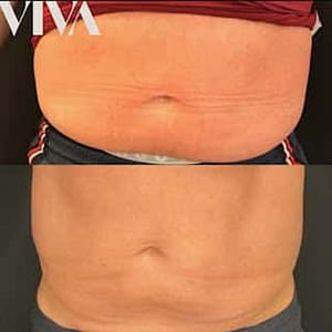 fat dissolving fat dissolving