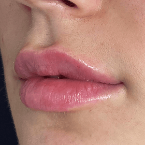 lip filler after