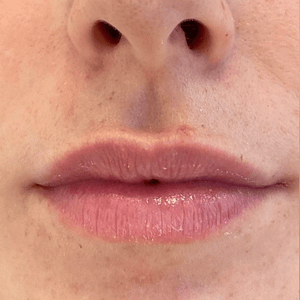 5 lip filler