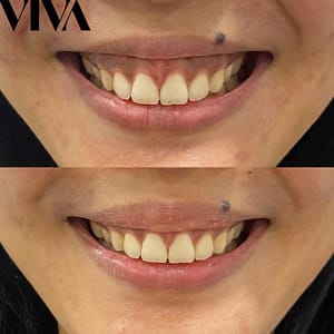 lucy before and after 2 300x300 gummy smile
