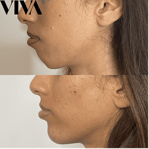 Chin Filler 300x300 Chin Filler 300x300