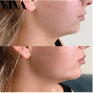 Jawline Filler 300x300 Jawline Filler London