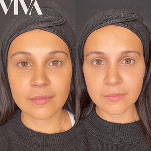 Cheek Filler cheek fillers, cheek fillers before and after