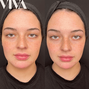 Facial contouring