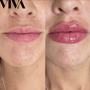 lip fillers