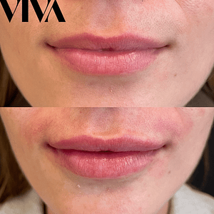 Screenshot 2022 10 06 at 16.18.59 300x300 lip fillers