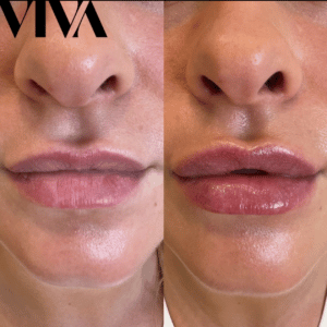 Screenshot 2022 10 06 at 17.59.38 300x300 lip fillers