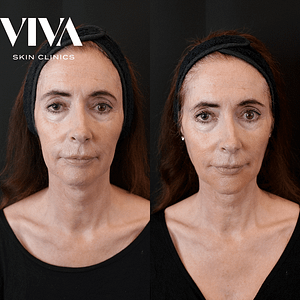 Sculptra before and after