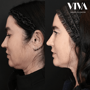 Buccal Fat pad injections