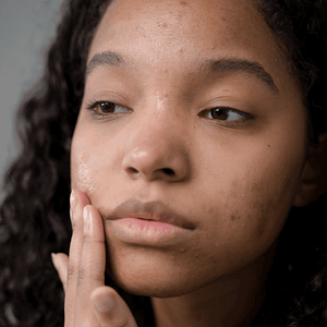 All Conditions 24 Condition-Acne-Scarring-at-Viva