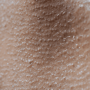All Conditions 33 Condition-Hyperhidrosis-at-Viva