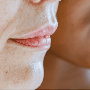 All Conditions 5 Condition-Thin-Lips-at-Viva