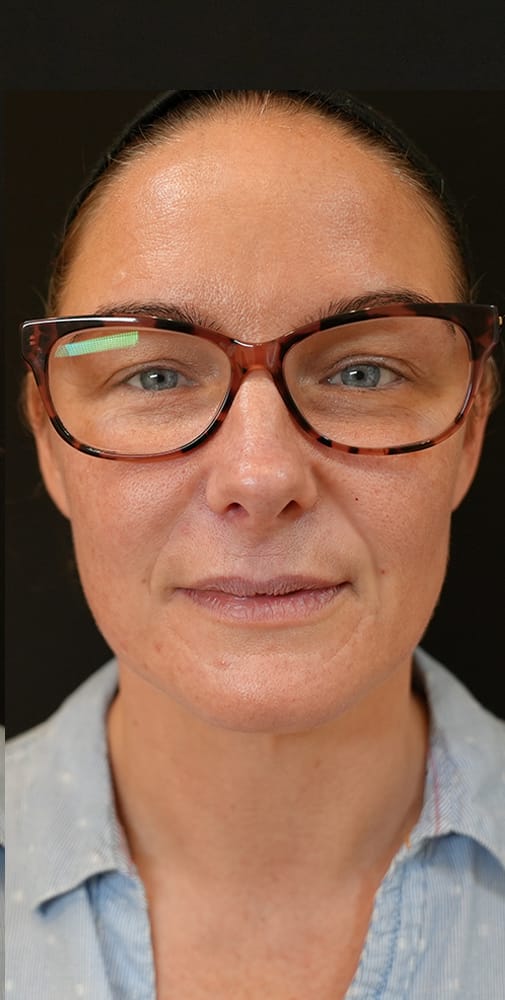 nose to mouth lines treatment with dermal filler after photo