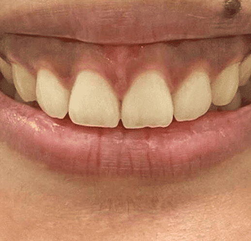 lip flip, gummy smile before
