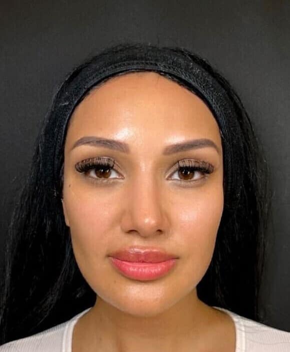 hydrafacial before and after