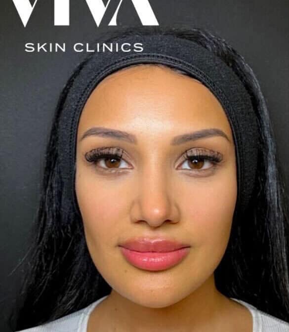 Before & Afters 10 hydrafacial before and after e1787996967400
