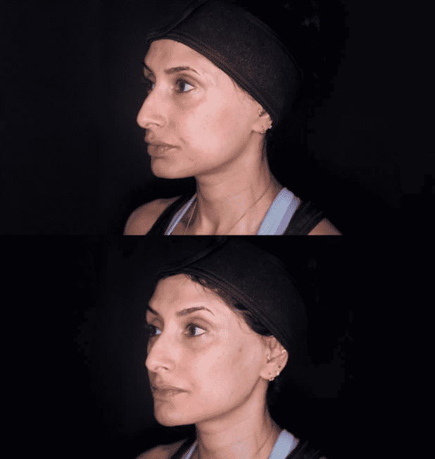 Before & Afters 20 Non surgical facelift before after