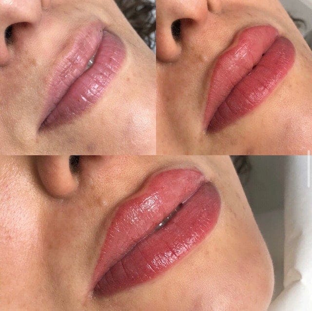 Before & Afters 7 lip filler