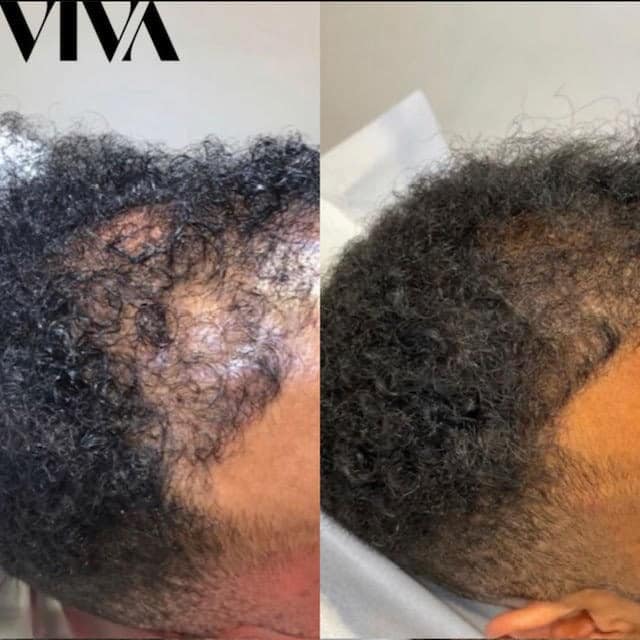 Before & Afters 8 prp hair treatment