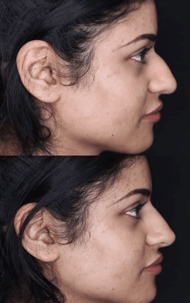 Before & Afters 4 nose filler before after