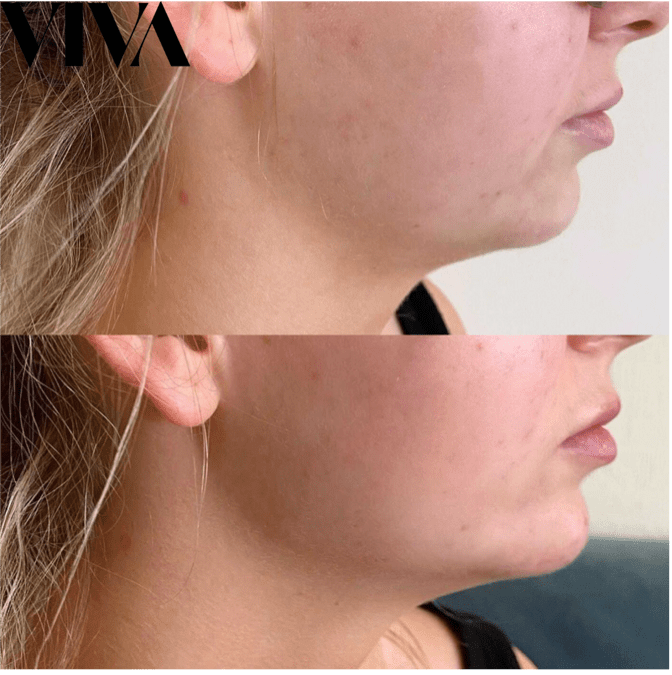 Before & Afters 17 Jawline Filler