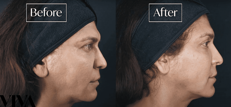 Before & Afters 13 full face filler
