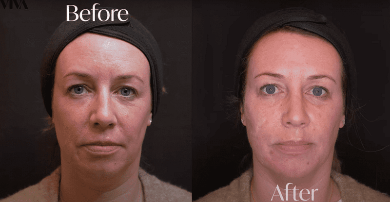 Before & Afters 19 5ml dermal filler before after 2