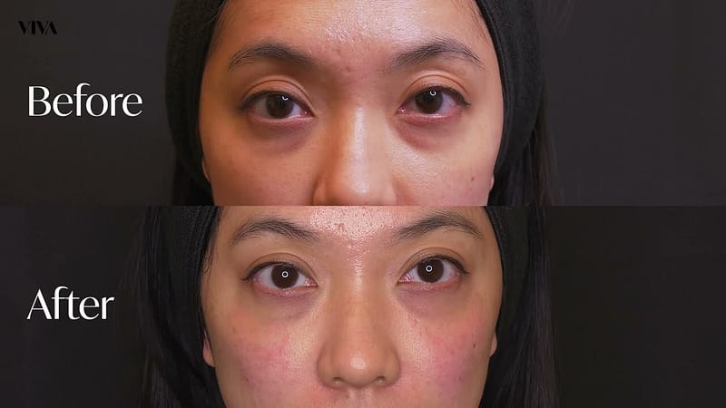 Does tear trough filler reduce wrinkles? 2 Tear Trough Filler