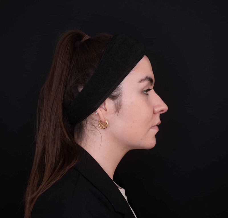 Dermal Filler After 3