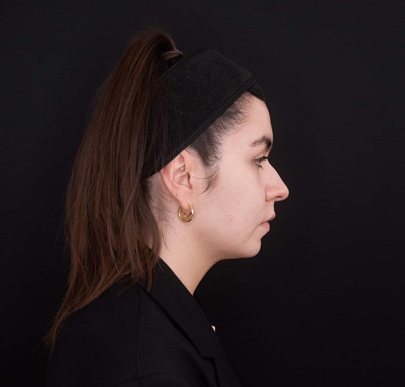 symmmertry correct, chin filler, facial balancing procedure before filler.