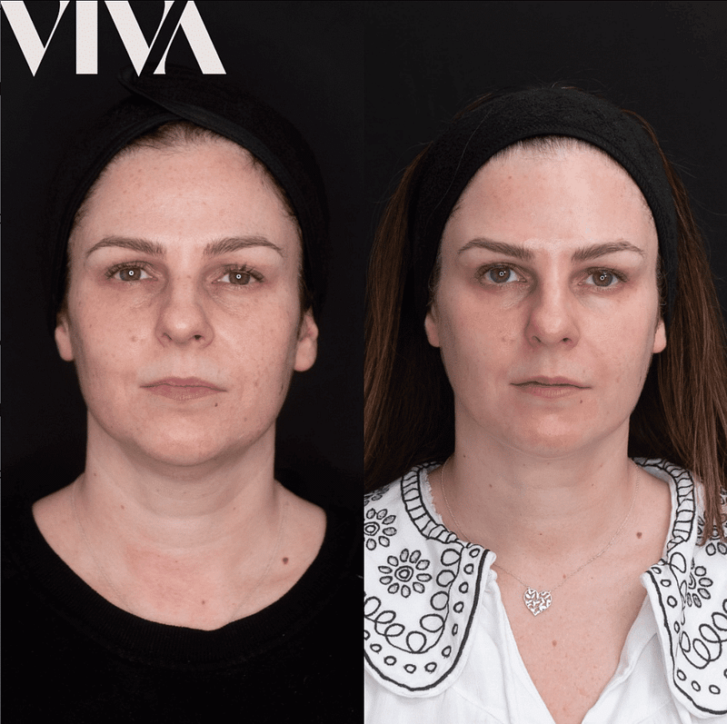 Before & Afters 1 dermal filler before after