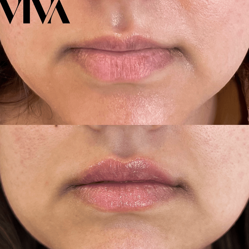 Before & Afters 22 lip filler before after 4