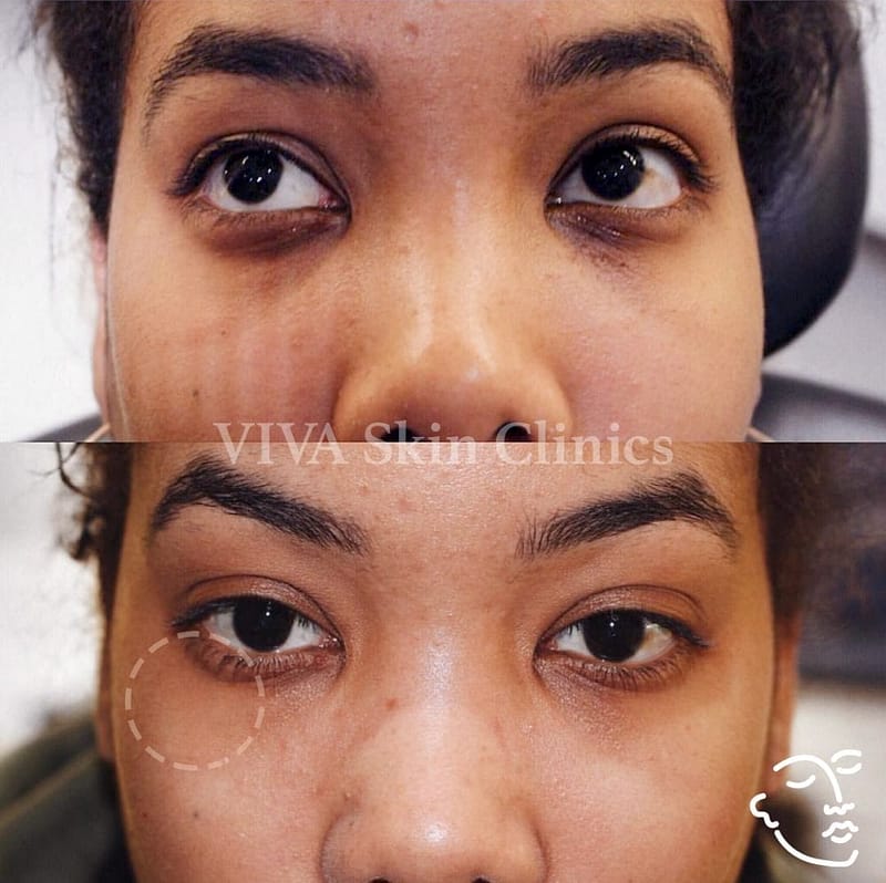 Tear trough filler for women before and after
