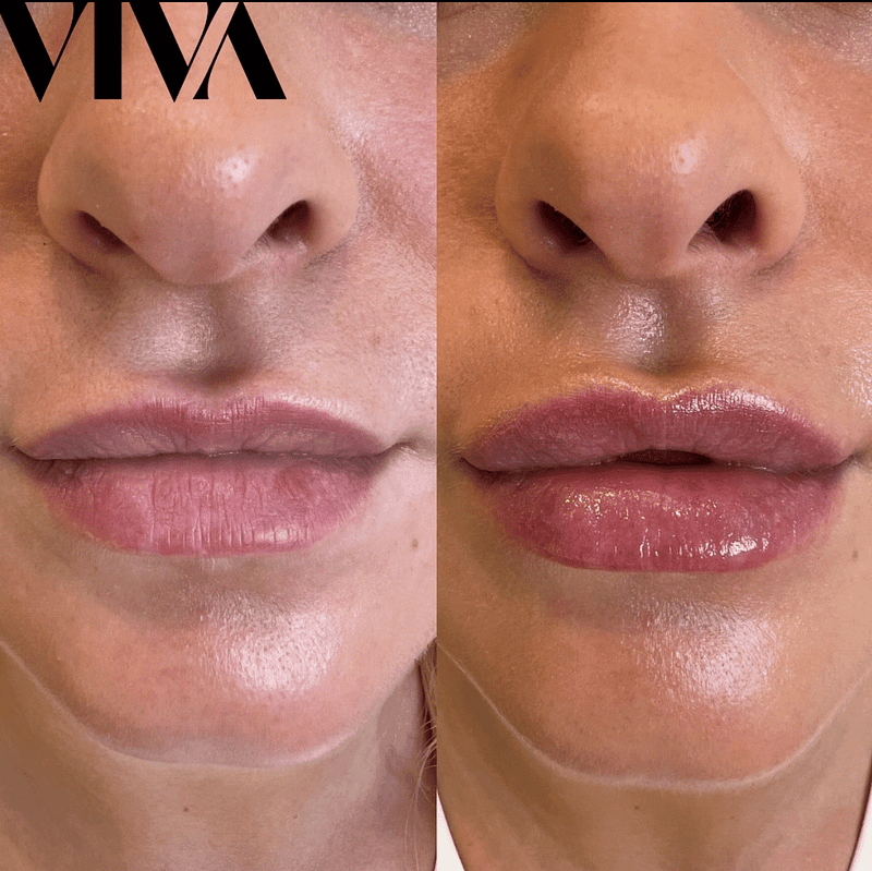 Before & Afters 21 lip filler before after 5