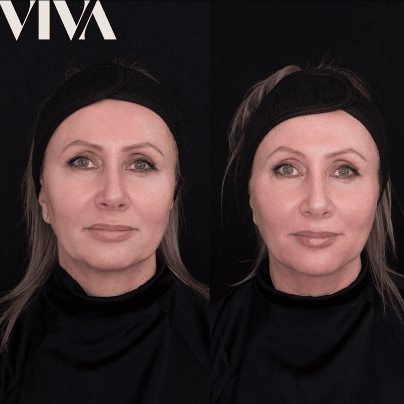 Before & Afters 29 non surgical facelift 2
