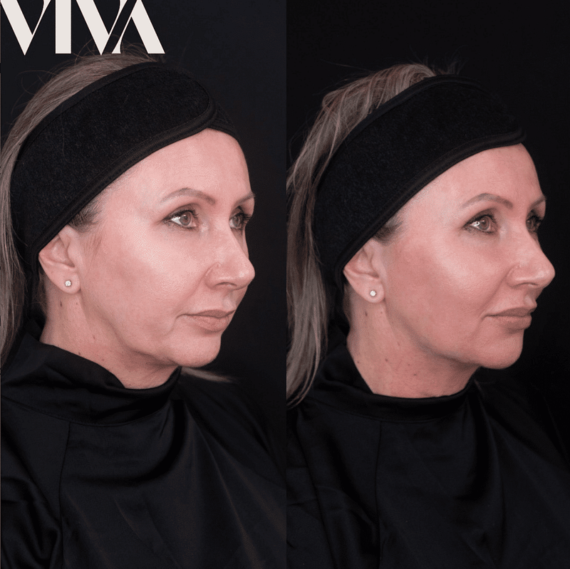 Before & Afters 5 non surgical facelift