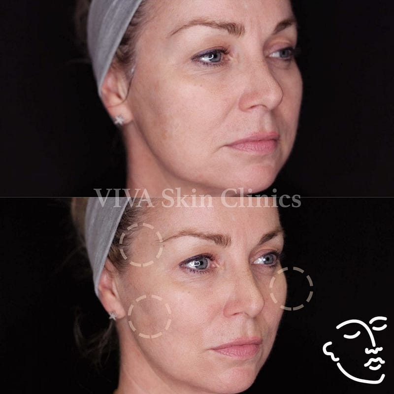 VIVA Skin Clinics 3D Face Refresh results