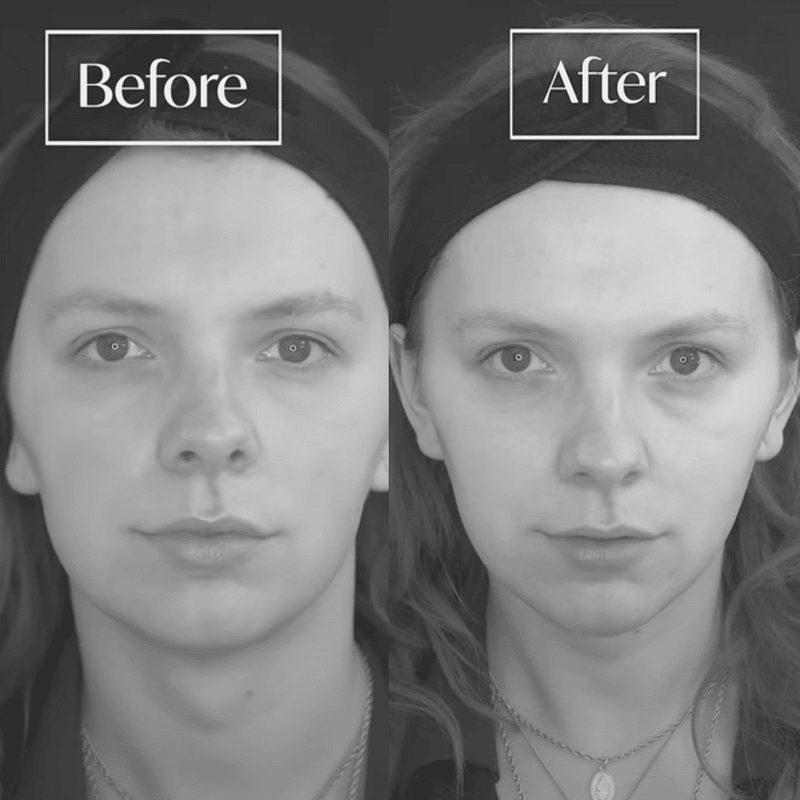 Facial feminisation