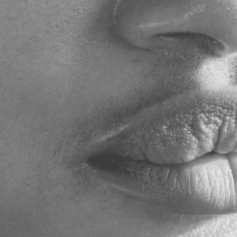 bruising after lip fillers