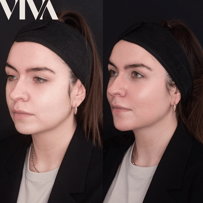 Before & Afters 3 11mls temple chin contour cheek tear trough non surgical nose jawline