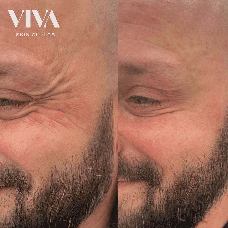 Botox before and after of crows feet in a man